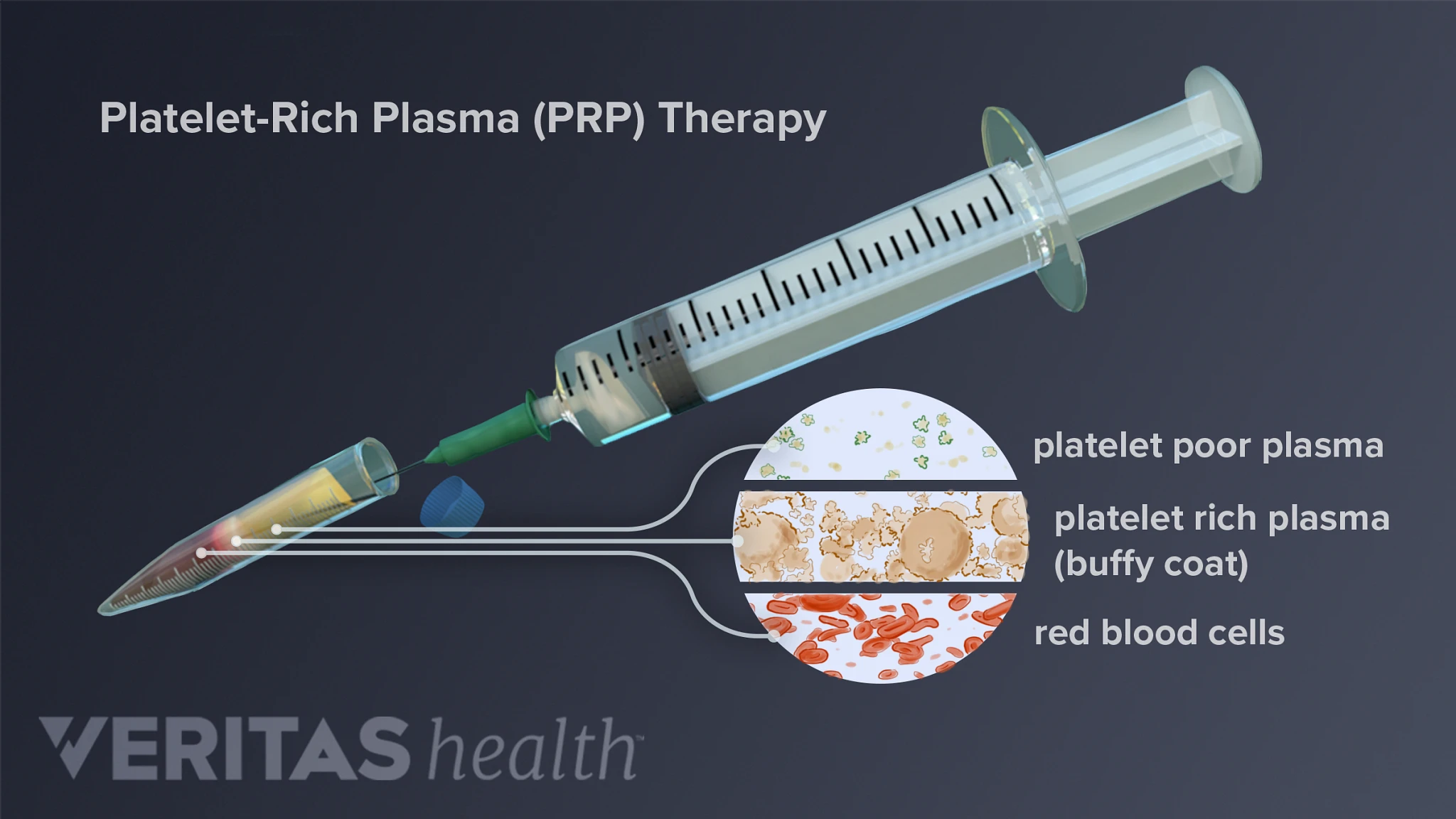 Platelet-Rich Plasma Injection Procedure | Arthritis-health