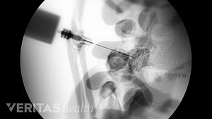 Xray image of a facet joint injection.