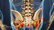 Posterior view of isthmic spondylolisthesis in the lumbar spine.