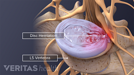 Medical illustration of a herniated disc and extruded material and the L4-L5 segment of the lumbar spine