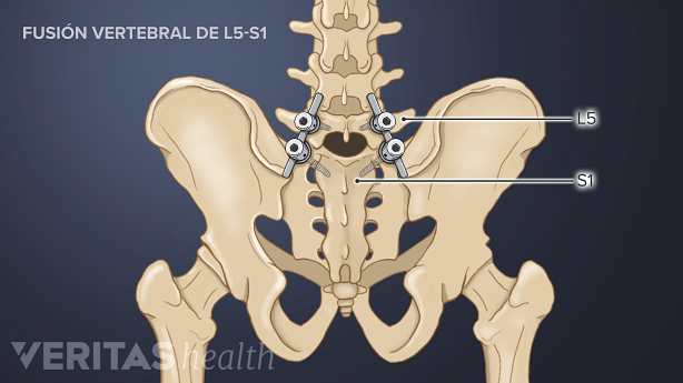 Fusión vertebral del nivel L5-S1.