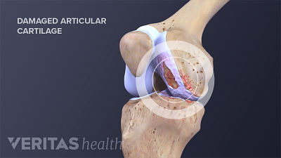 膝关节股骨标签、髌骨关节软骨和胫骨。