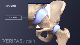 als je kunt Malaise scheerapparaat 3 Types of Snapping Hip Syndrome | Sports-health
