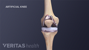 Medical illustration of a completed knee replacement