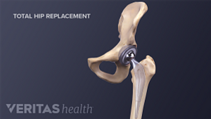 Medical illustration of a total hip replacement for osteoarthritis