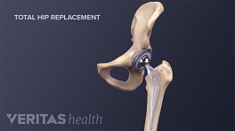 Illustration of total hip replacement for hip osteoarthritis