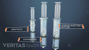 Tres jeringas utilizadas como inyección de esteroides epidurales lumbares.