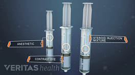 Tres jeringas que muestran tres componentes de inyección, tinte de contraste, anestésico y mezcla de inyección de esteroides