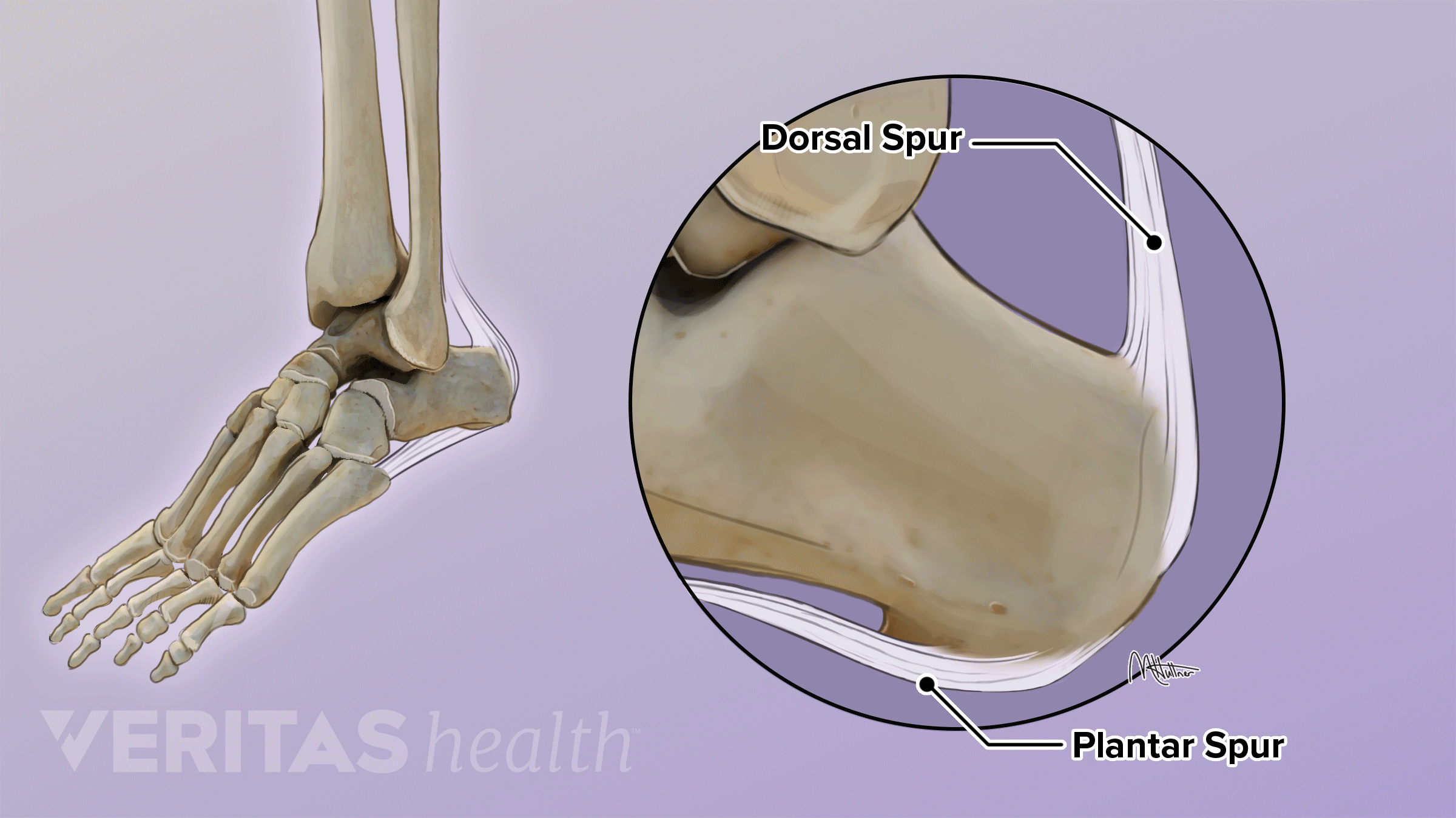Animation showing pain points of plantar spur and dorsal spur