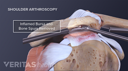 Arthroscopic repair of a shoulder impingement