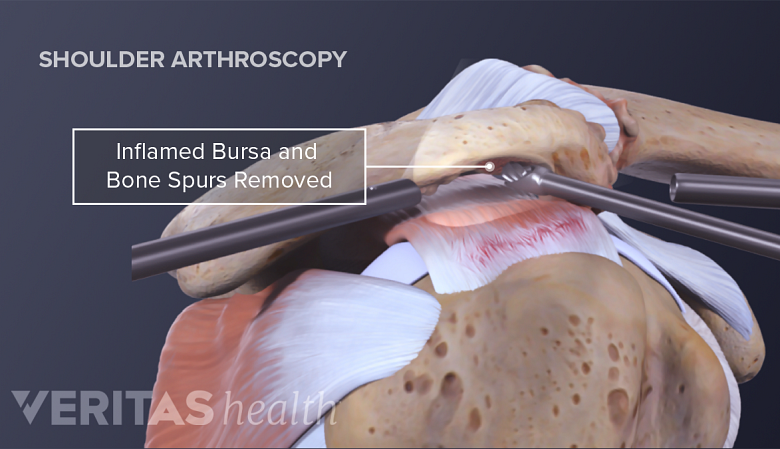 Illustration showing arthroscopic surgery of shoulder joint.