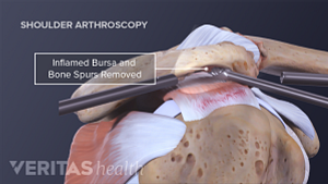 Arthroscopic repair of a shoulder impingement