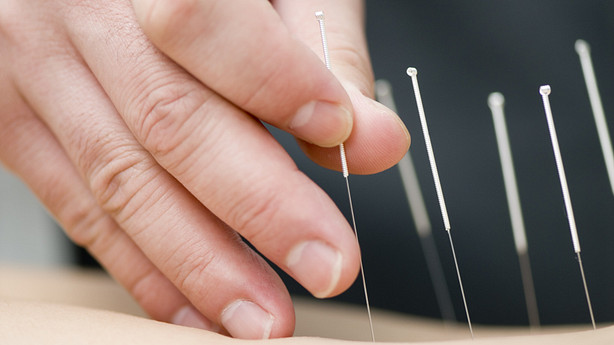 Acupuncture needles being placed on a back
