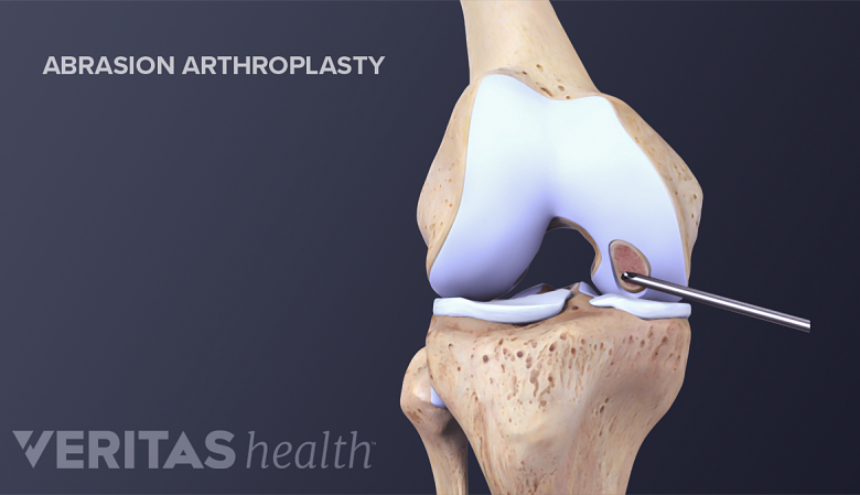 Illustration showing knee abrasion surgery.