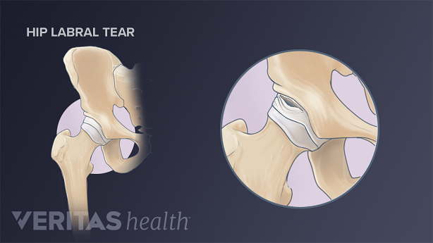 Medical illustration of an intra articular hip labral tear
