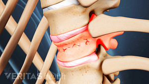 Close up medical illustration of a vertebrae with a compression fracture. The disc above the fracture is highlighted in red to indicate pain.