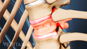Medical illustration of a vertebral compression fracture