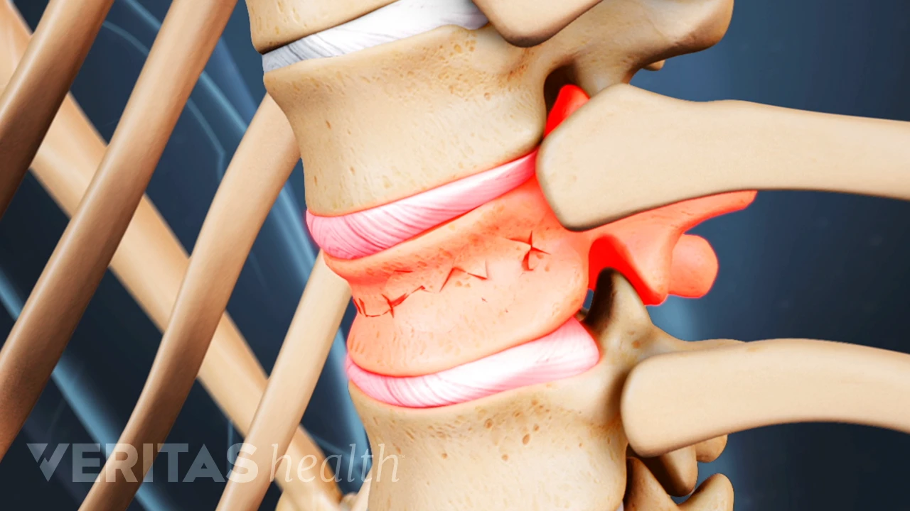 Signs and Complications of Osteoporosis | Spine-health Signs and Complications of Osteoporosis | Spine-health