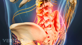 Medical illustration of the lower spine, highlighted in red indicating pain, numbness or tingling