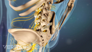 Vista posterior de la columna lumbar con un vendaje en el sitio de la epidural.