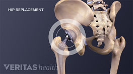 Medical Illustration of a hip implant in posterior view