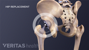 Medical Illustration of a hip implant in posterior view