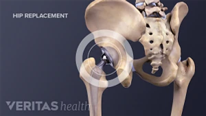 Total Hip Replacement: Types, Procedures, Recovery, Exercises