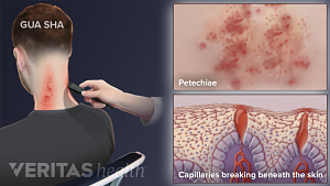 Gua Sha showing petechiae and capillaries breaking beneath the skin