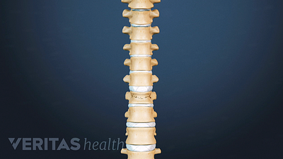 Spinal Compression Fracture Video