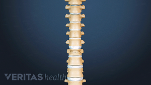 Anterior view of the spine showing a fracture in a thoracic vertebra.