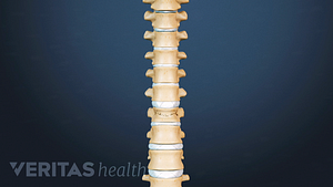 Anterior view of thoracic spine showing vertebrae with compression fracture.