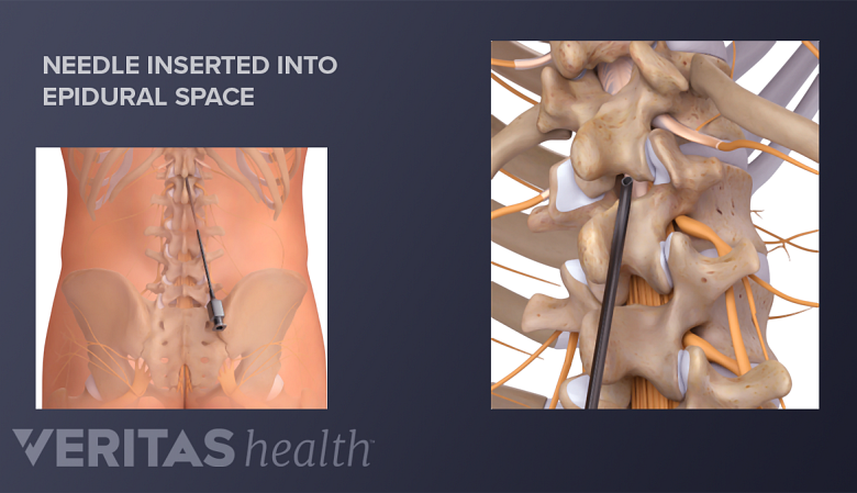 A needle is inserted into the epidural space of the lumbar spine.
