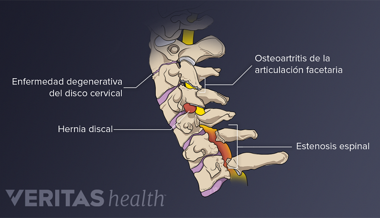 Condiciones que pueden ocurrir en la columna cervical.