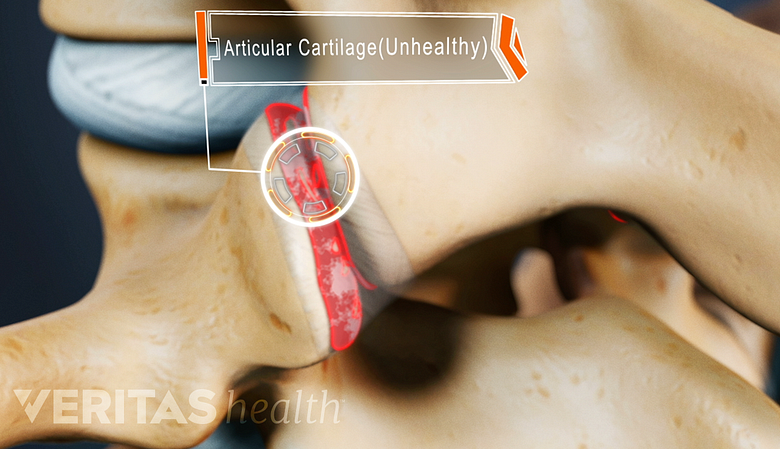 Medical animation showing unhealthy articular cartilage in the facet joints of the lumbar spine