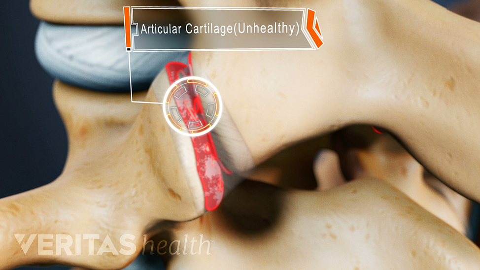 Animated video still highlighting unhealthy articular cartilage