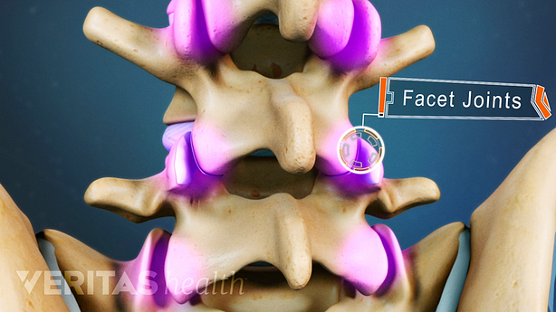 Illustration of the lumbar spine with facet joints highlighted.