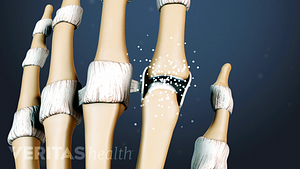 Close up illustrated view of arthritis in the finger joints