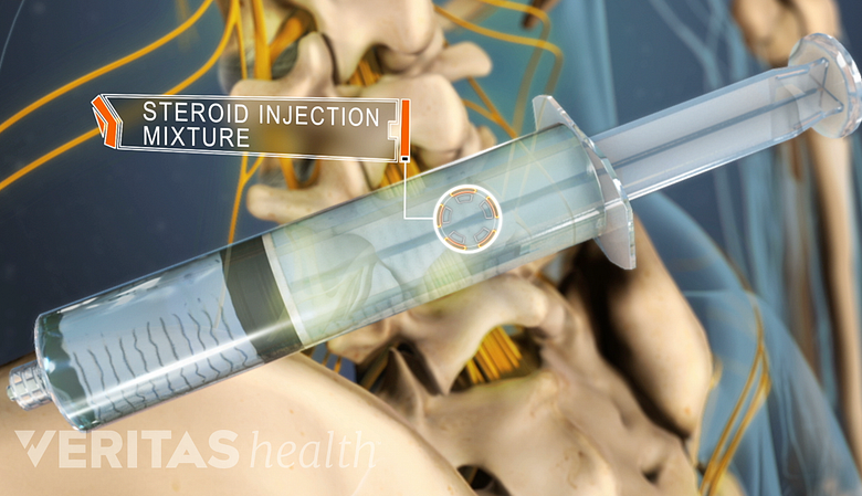 Epidural Steroid Injections in the spine