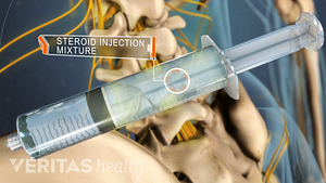 Mezcla de inyección de esteroides en una jeringa frente a la columna lumbar.