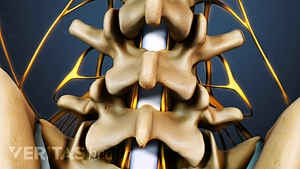 Posterior view of lumbar spine for fusion location.