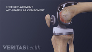 Profile view of replaced knee joint with patellar component