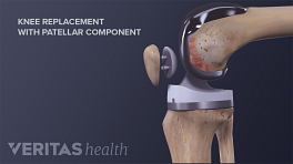 Medical illustration of replaced knee joint