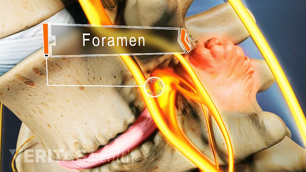 Medical illustration showing bone spurs crowding the space in the foramen, the space where nerves exit the spinal canal