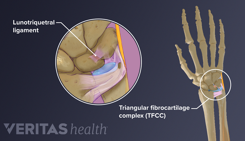 lunotriquetral ligament and triangular fibrocartilage complex (TFCC) tears in the wrist