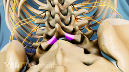 Non-Surgical Treatment for Spinal Stenosis in Huntsville