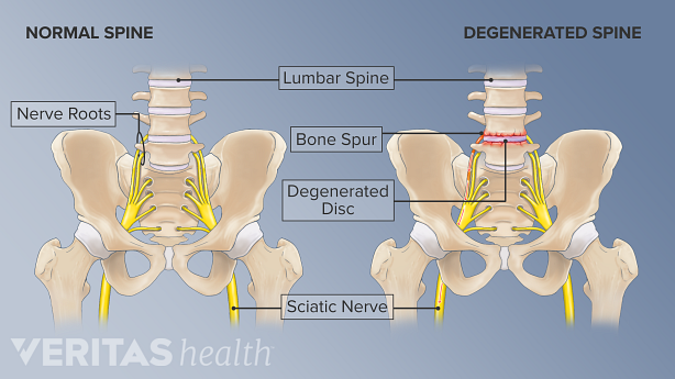 Illustration of the normal lumbar spine and a degenerated lumbar spine highlighting bone and disc problems.