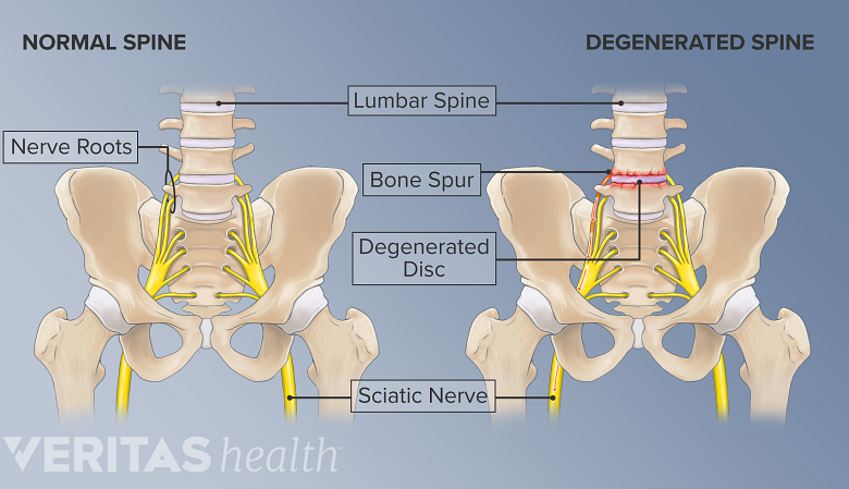 An illustration showing  normal and a degenerated spine.
