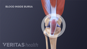 Pus inside knee bursa