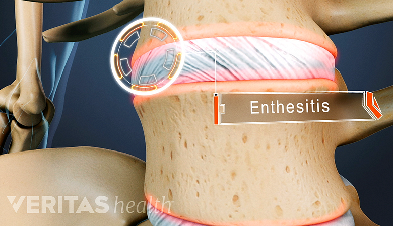 Location of an inflamed enthesis in a vertebral segment.