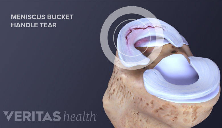 Illustration of anatomy of knee with bucket handle tear.